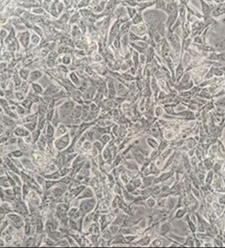 Magnified photo of Fibrosarcoma cells